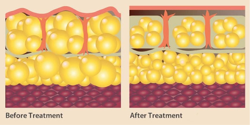 renewwave-before-after